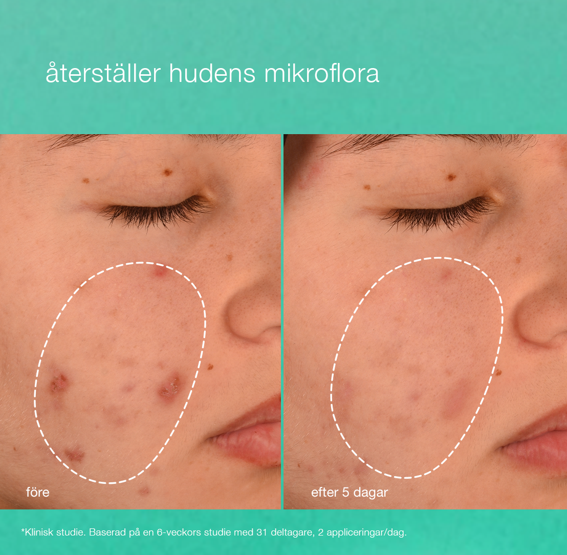 Breakout Biotic Moisturizer_3